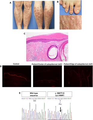 A case of dominant dystrophic epidermolysis bullosa pruriginosa with a novel mutation in the hinge region of COL7A1